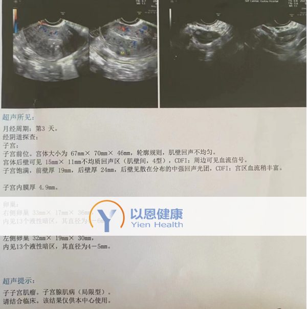 以恩健康：38岁高龄伴子宫肌瘤等问题在哈萨克斯坦助孕成功